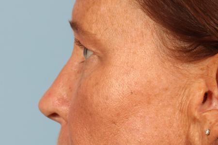 Before image 3 Case #116506 - Upper Eyelid Contouring