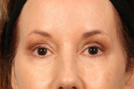 After image 1 Case #116486 - Upper Eyelid Contouring