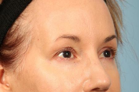 Before image 2 Case #116486 - Upper Eyelid Contouring