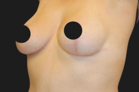 After Case #116791 - 42 year-old patient | Breast Lift 