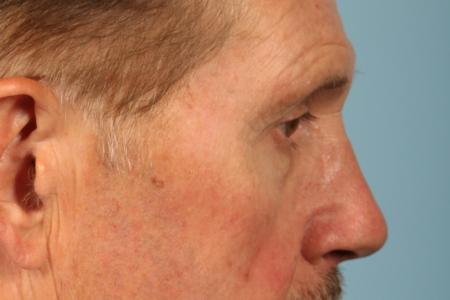 After image 3 Case #116511 - Male Eyelid Contouring