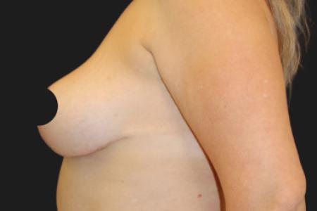 After Case #116791 - 42 year-old patient | Breast Lift 