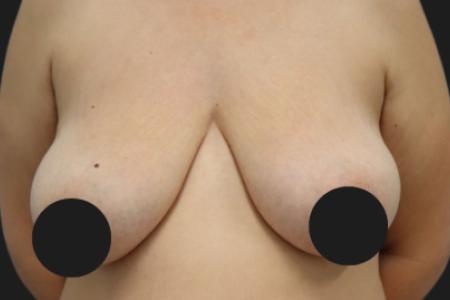 Before Case #116791 - 42 year-old patient | Breast Lift 