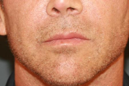 Before image 1 Case #118701 - Male Upper Lip Lift Before image 1 Case #118701 - Male Upper Lip Lift