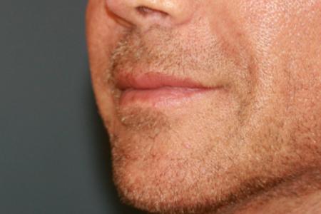 Before image 2 Case #118701 - Male Upper Lip Lift Before image 2 Case #118701 - Male Upper Lip Lift