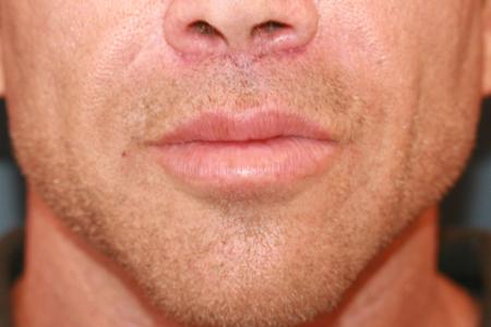 After image 1 Case #118701 - Male Upper Lip Lift After image 1 Case #118701 - Male Upper Lip Lift