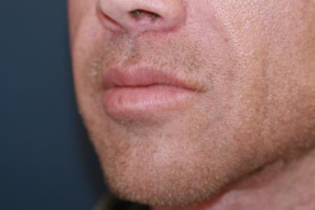 After image 2 Case #118701 - Male Upper Lip Lift After image 2 Case #118701 - Male Upper Lip Lift