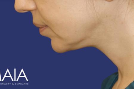 After Case #119361 - 43 year-old Patient | Neck Lift After Case #119361 - 43 year-old Patient | Neck Lift