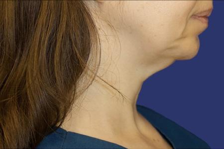 Before Case #119361 - 43 year-old Patient | Neck Lift Before Case #119361 - 43 year-old Patient | Neck Lift