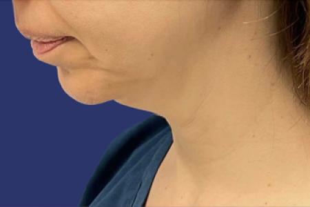 Before Case #119361 - 43 year-old Patient | Neck Lift Before Case #119361 - 43 year-old Patient | Neck Lift