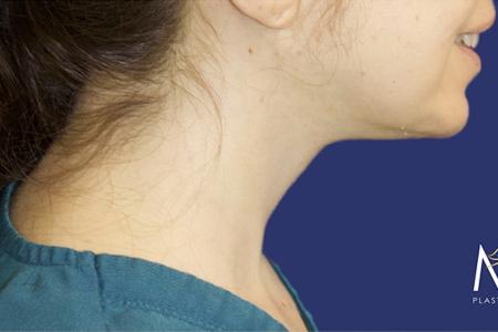 After Case #119361 - 43 year-old Patient | Neck Lift After Case #119361 - 43 year-old Patient | Neck Lift