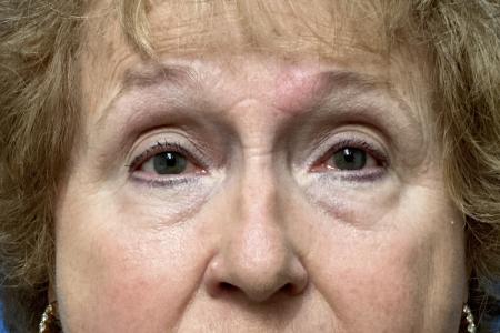 Before image 1 Case #123531 - 74 year old - Upper & Lower Bleph Before image 1 Case #123531 - 74 year old - Upper & Lower Bleph