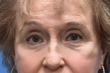 After image 1 Case #123531 - 74 year old - Upper & Lower Bleph After image 1 Case #123531 - 74 year old - Upper & Lower Bleph