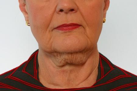 Before image 1 Case #125916 - Neck Lift Before image 1 Case #125916 - Neck Lift