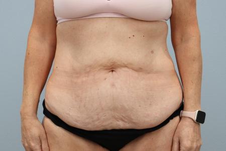Before image 1 Case #125556 - Tummy Tuck & Liposuction Results | Dr. Neaman Before image 1 Case #125556 - Tummy Tuck & Liposuction Results | Dr. Neaman