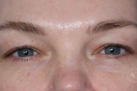 Before image 1 Case #125786 -  Upper blepharoplasty Before image 1 Case #125786 -  Upper blepharoplasty