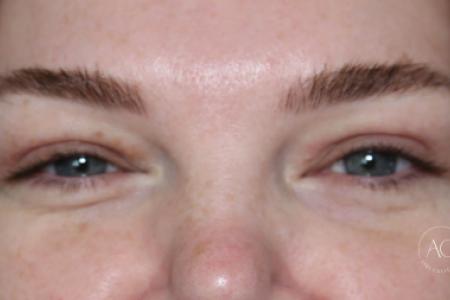 After image 1 Case #125786 -  Upper blepharoplasty After image 1 Case #125786 -  Upper blepharoplasty