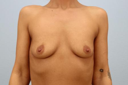 Before image 1 Case #125521 - 560cc Silicone Breast Augmentation | 6-Month Resul Before image 1 Case #125521 - 560cc Silicone Breast Augmentation | 6-Month Resul