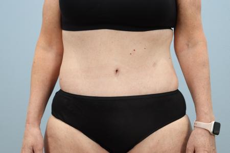 After image 1 Case #125556 - Tummy Tuck & Liposuction Results | Dr. Neaman After image 1 Case #125556 - Tummy Tuck & Liposuction Results | Dr. Neaman