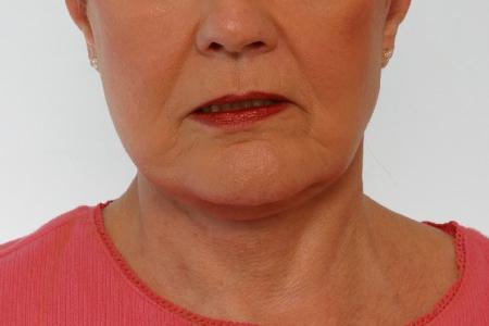 After image 1 Case #125916 - Neck Lift After image 1 Case #125916 - Neck Lift