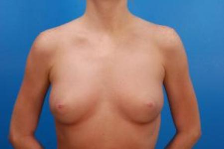 Before image 1 Case #85326 - Natural primary breast augmentation to a full C breast